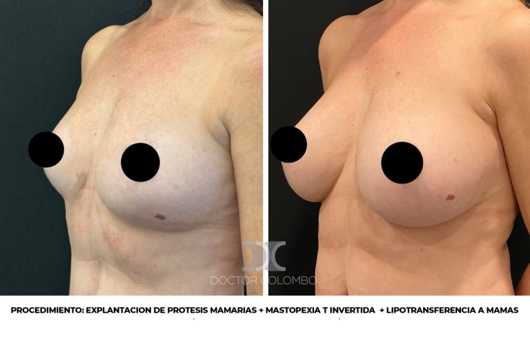 Antes y después de Retirada de prótesis