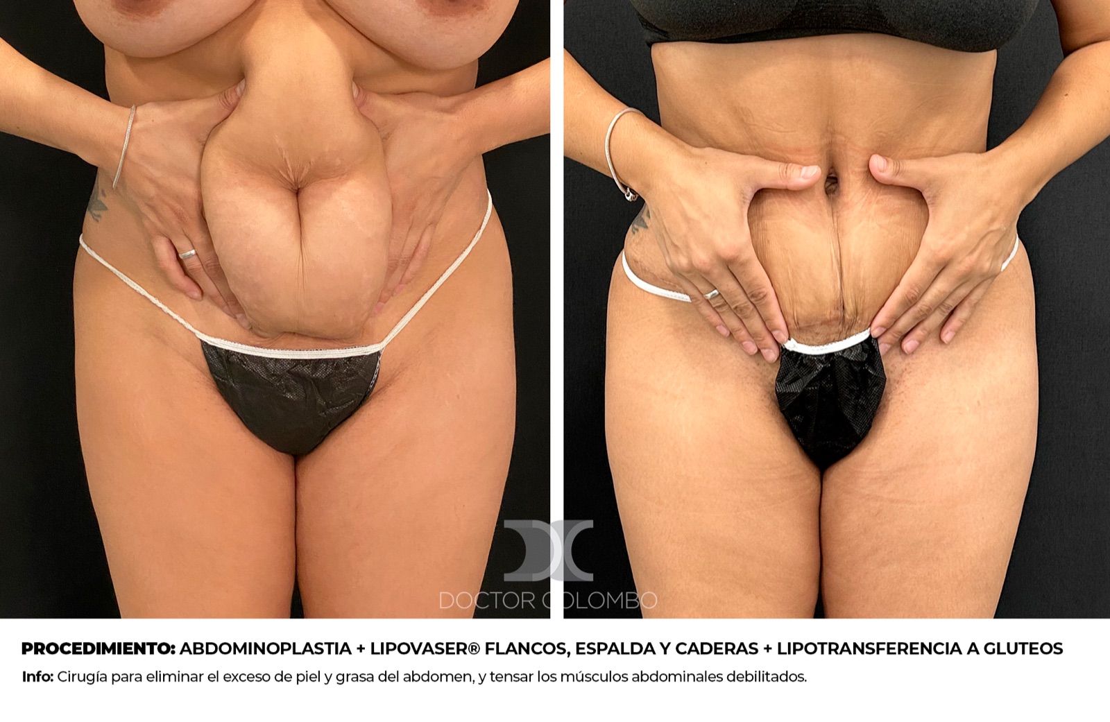 Antes y despues Lipotransferencia Gluteos