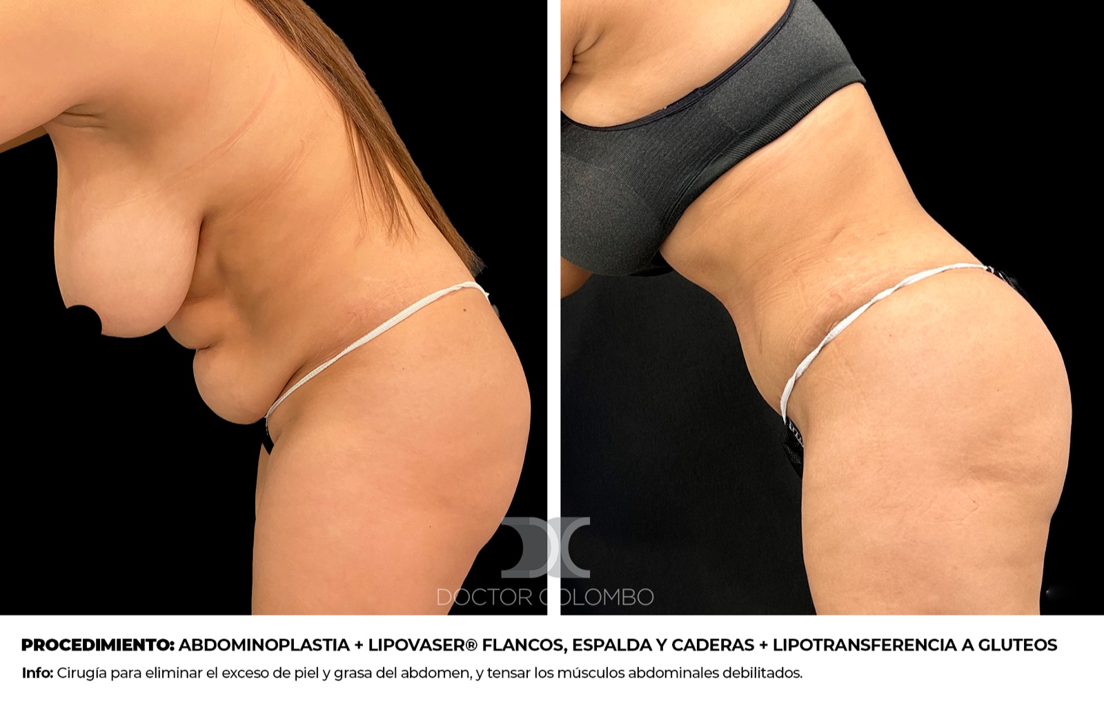 Resultado BBL lipotransferencia gl&uacute;teos Madrid