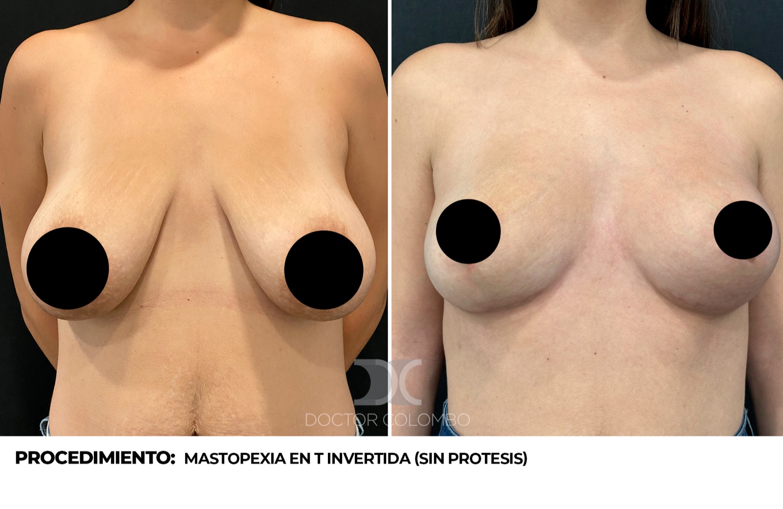 Antes y despues Mastopexia