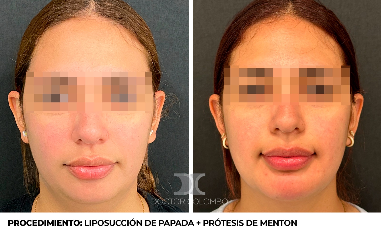 Resultado de mentoplastia - antes y después, vista frontal