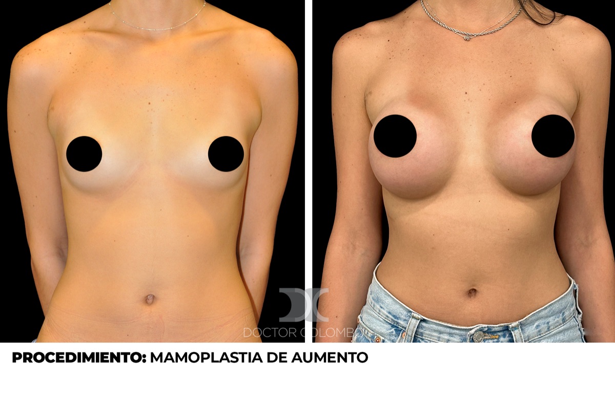 Antes y despues Aumento de Pecho
