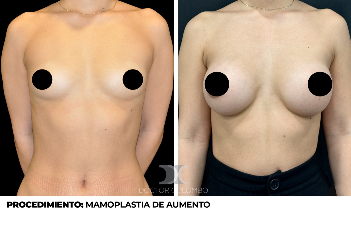 Antes y despues Aumento de Pecho