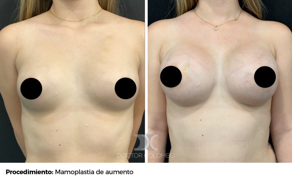 MPA — 1078 — Perfil izquierdo