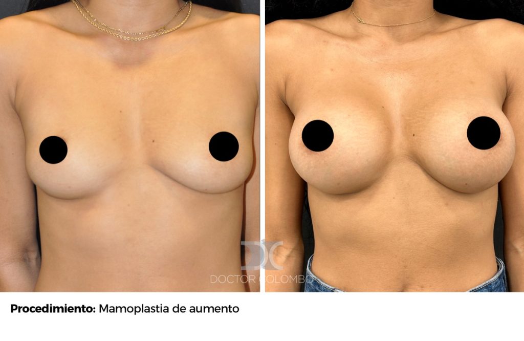 MPA — 1079 — Perfil izquierdo