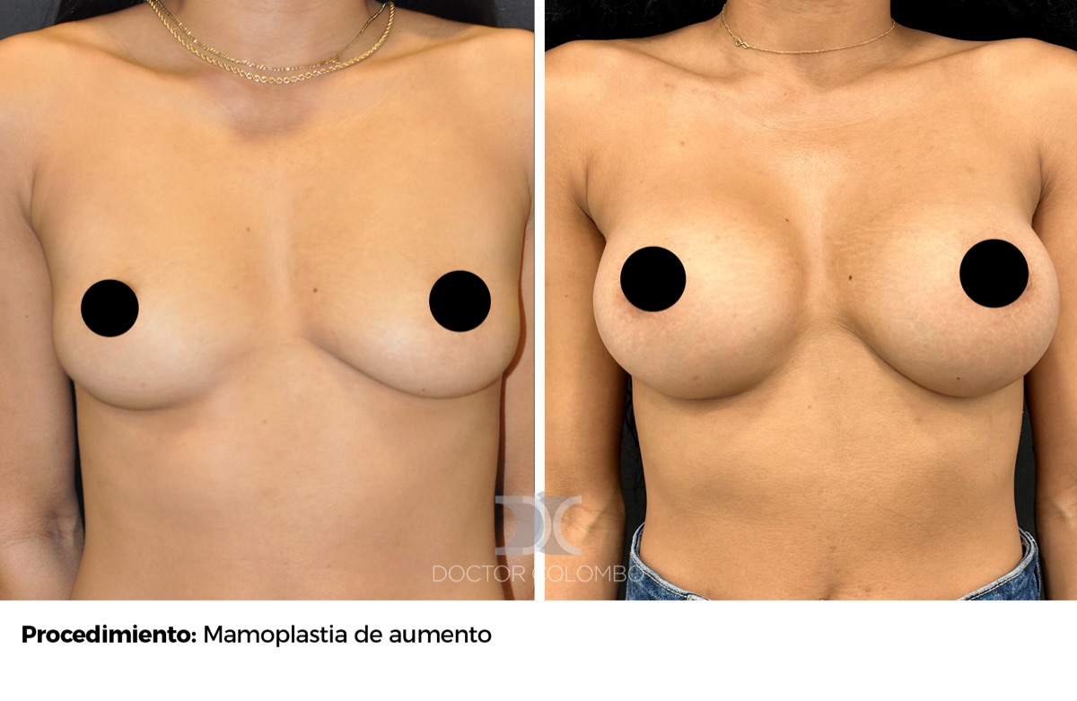 Antes y despues Aumento de Pecho