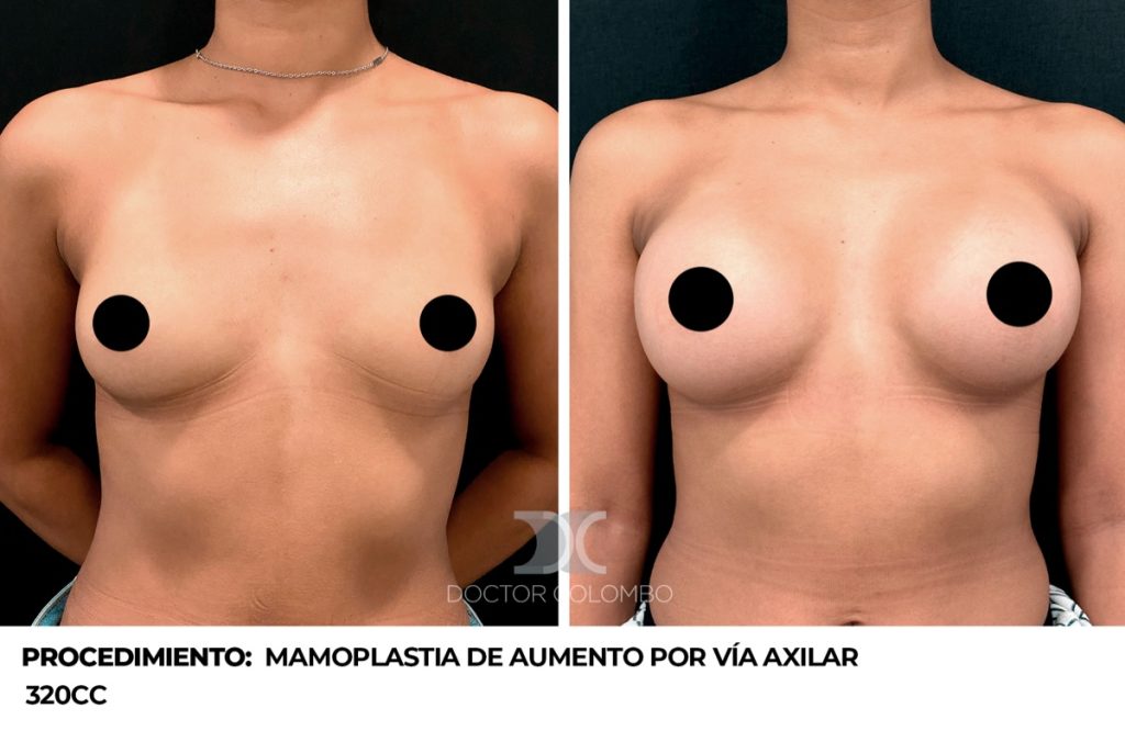 MPA AXILAR — 2650 — Perfil izquierdo