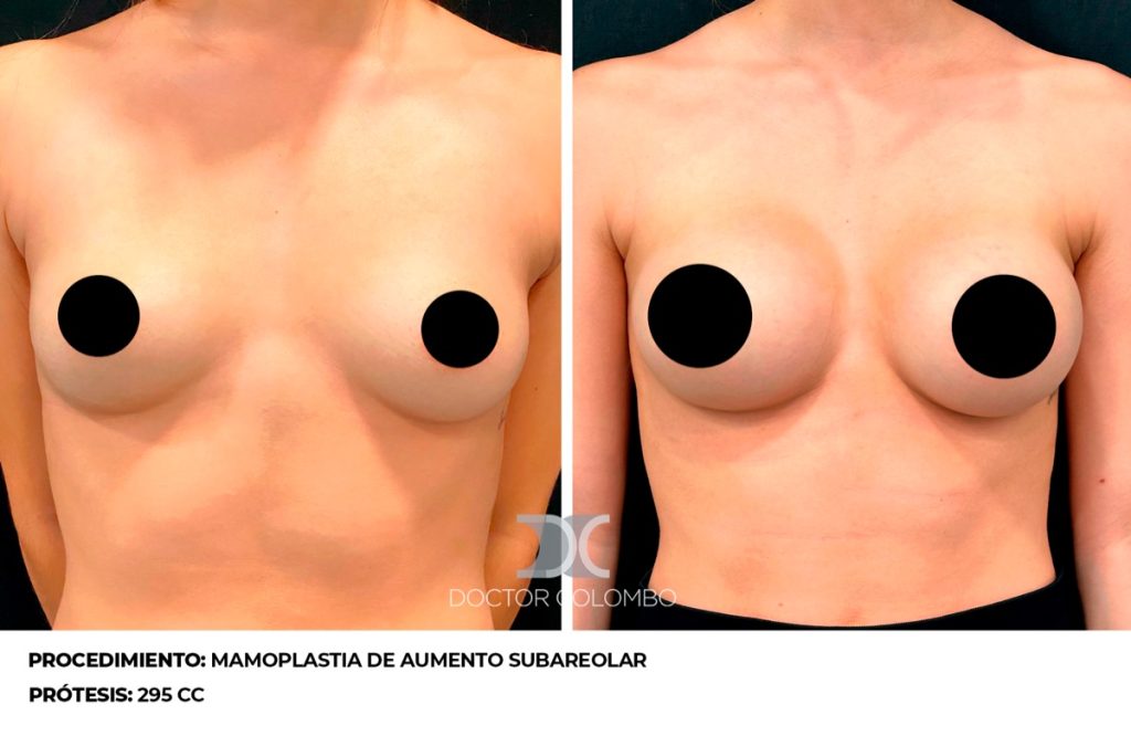 MAMOPLASTIA DE AUMENTO — 3115 — Perfil izquierdo