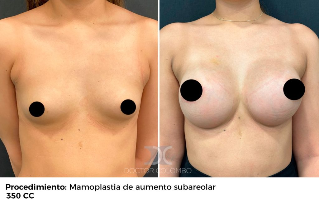 AUMENTO MAMARIA SUBAREOLAR CON PROTESIS — 4025 — Perfil izquierdo