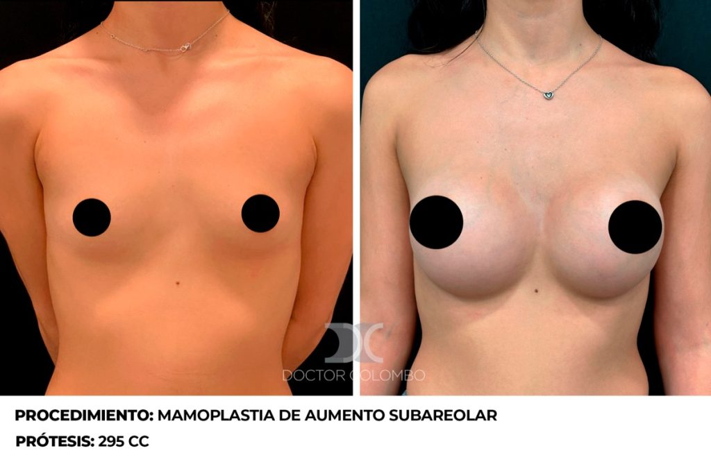 MAMOPLASTIA DE AUMENTO — 4344 — Perfil izquierdo