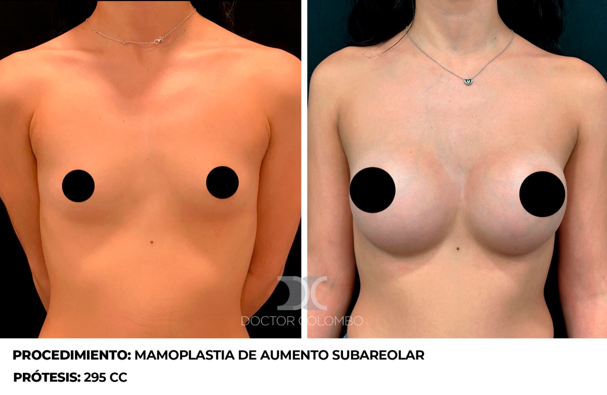 Antes y despues Aumento de Pecho