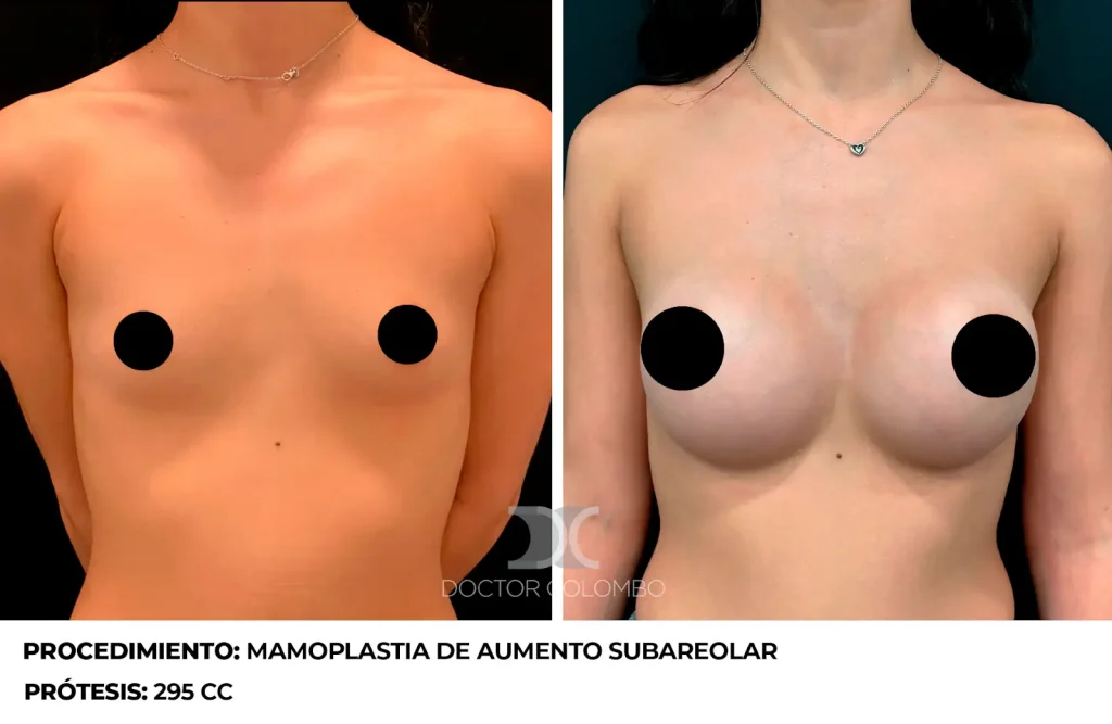 MAMOPLASTIA DE AUMENTO — 4344 — Perfil derecho