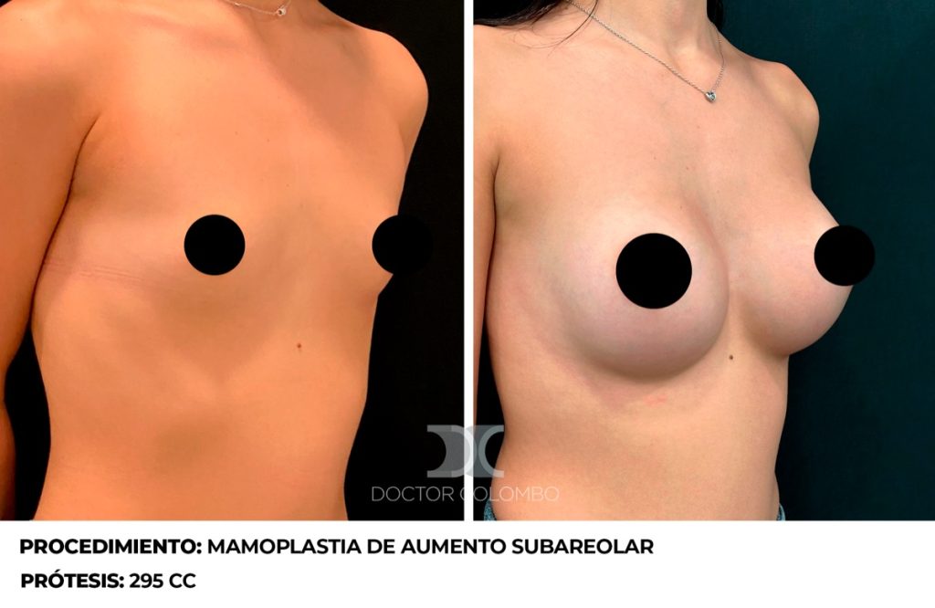 MAMOPLASTIA DE AUMENTO — 4344 — Frontal