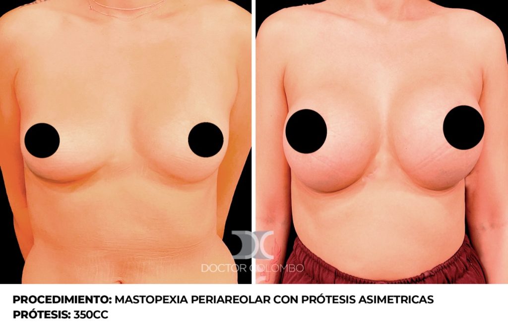 MAMOPLASTIA DE AUMENTO — 4478 — Perfil derecho