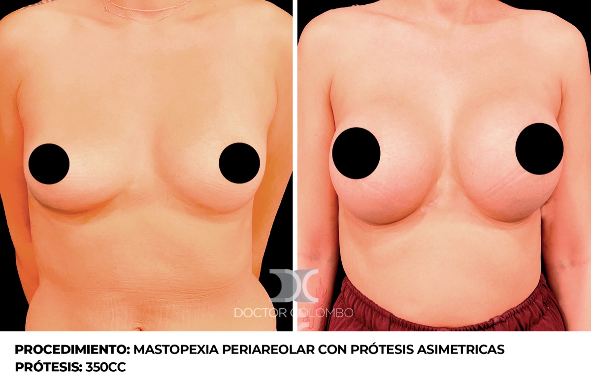 Antes y despues Aumento de Pecho