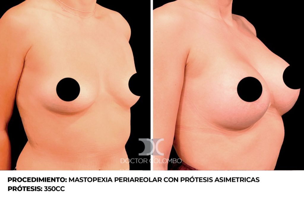 MAMOPLASTIA DE AUMENTO — 4478 — Perfil izquierdo