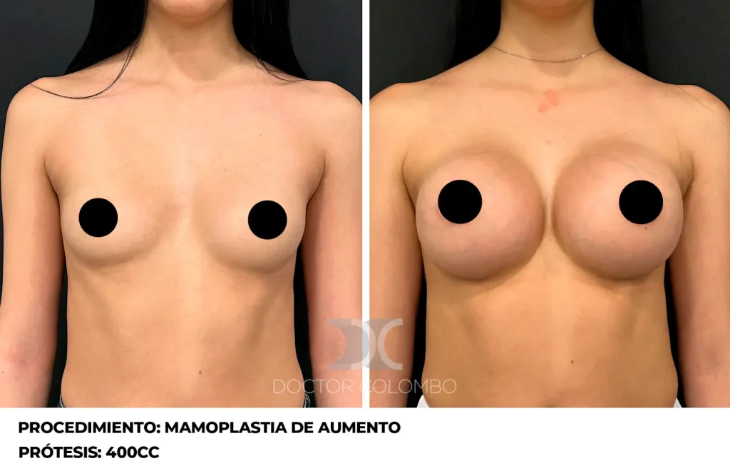 MAMOPLASTIA DE AUMENTO — 5627 — Perfil derecho