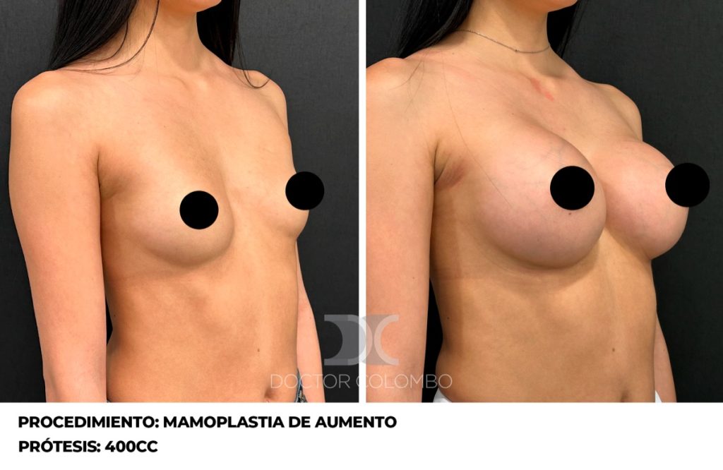 MAMOPLASTIA DE AUMENTO — 5627 — Frontal