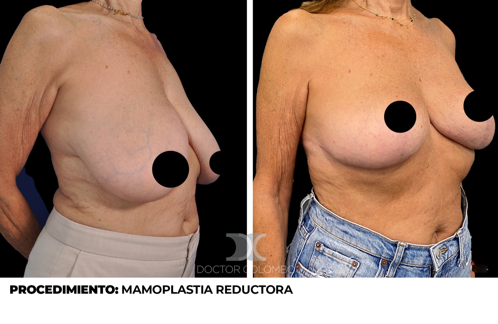 Antes y después mamoplastia reductora - vista lateral