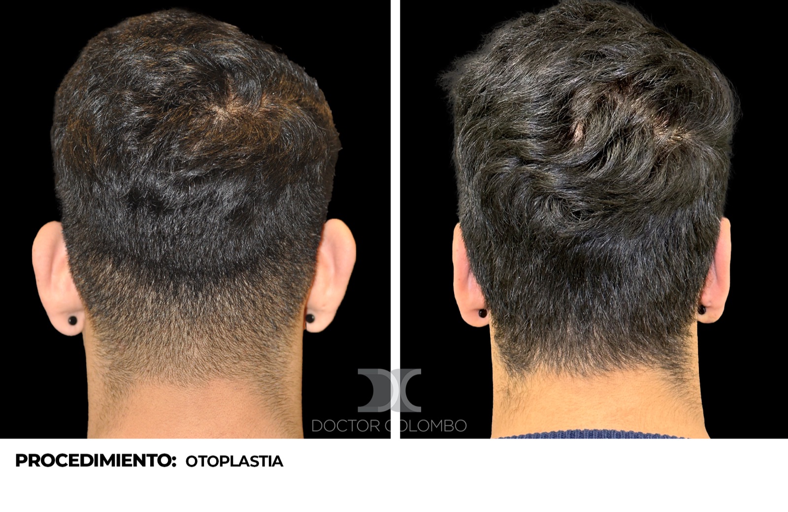 Resultado de otoplastia - antes y después, vista posterior