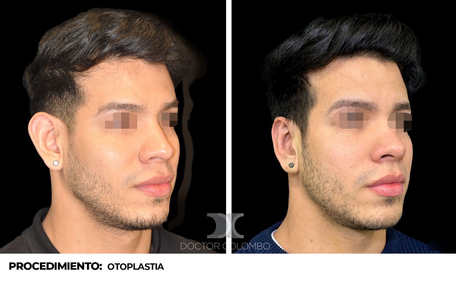 Antes y despues Otoplastia