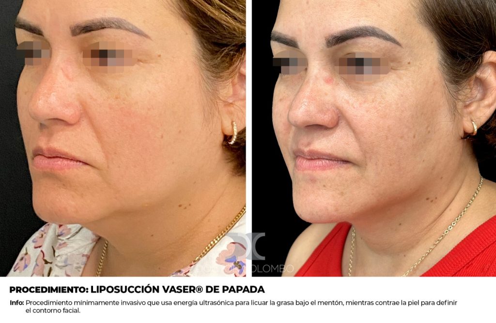 LIPOSUCCIÓN VASER® DE PAPADA  – CON ANESTESIA LOCAL – AMBULATORIO — 4671 — Vista 1
