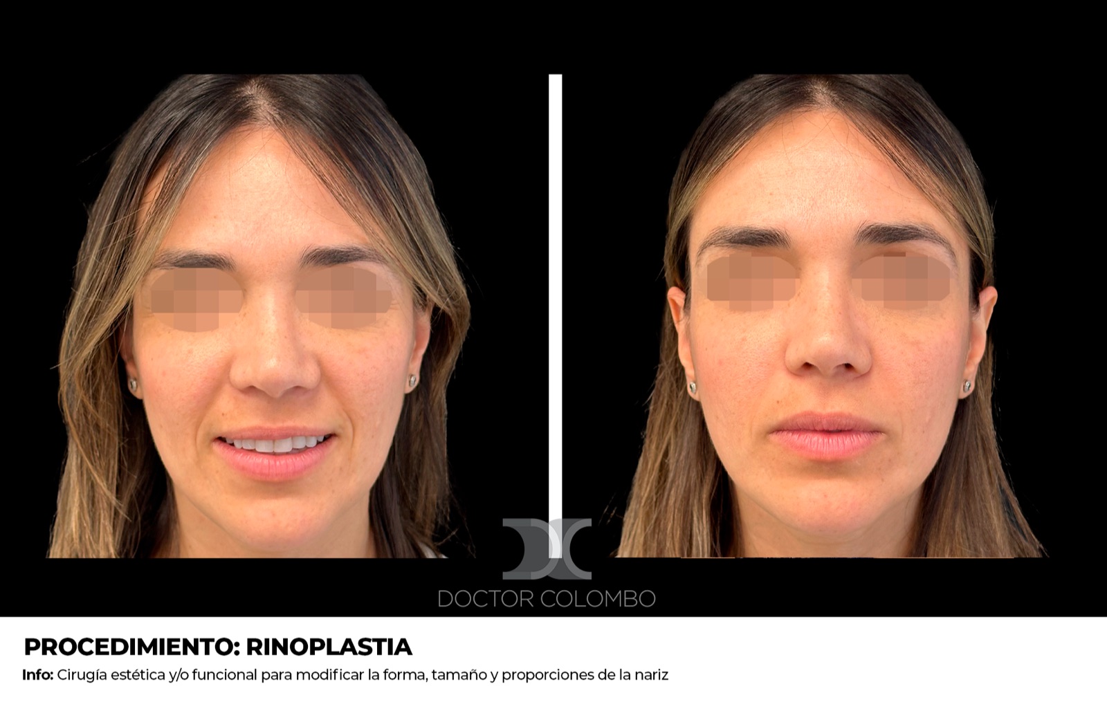 Resultado de rinoplastia de punta - antes y después, vista frontal