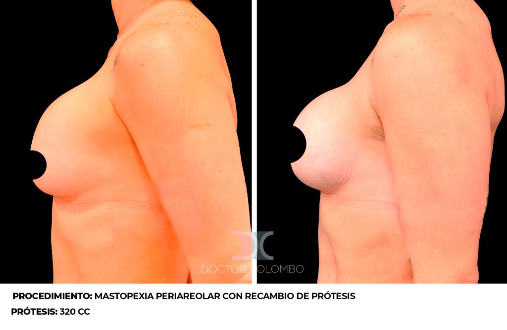 RECAMBIO PROTESIS POR VIA PERIAREOLAR  – SIN NOCHE DE HOSPITALIZACIÓN – ES COLABORACIÓN — 3713 — Frontal