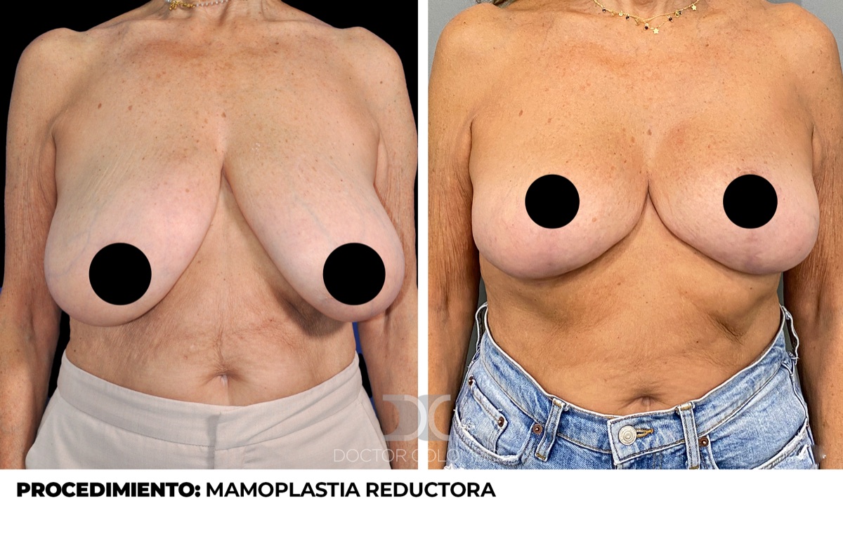 Resultado de mamoplastia reductora - Dr. Colombo