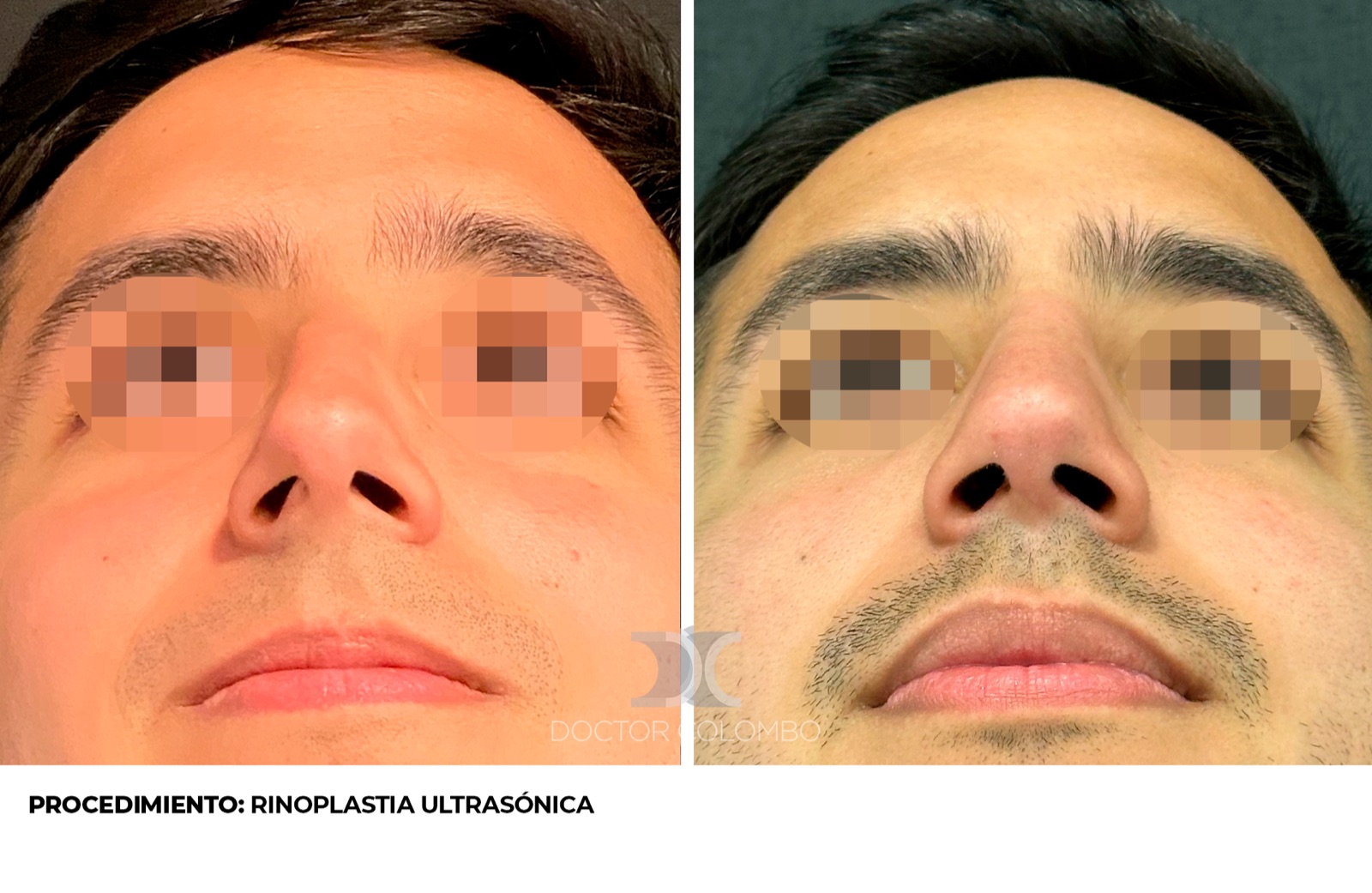 Resultado de risenoplastia - antes y después, vista frontal