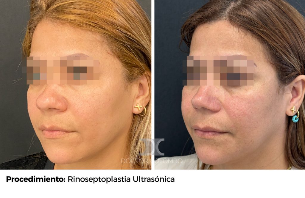 RINOSEPTOPLASTIA ULTRASÓNICA — 3896 — Perfil izquierdo