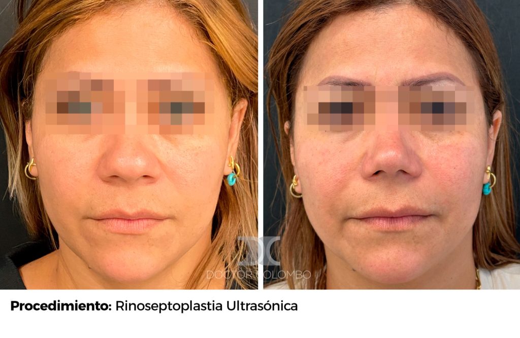 RINOSEPTOPLASTIA ULTRASÓNICA — 3896 — Frontal