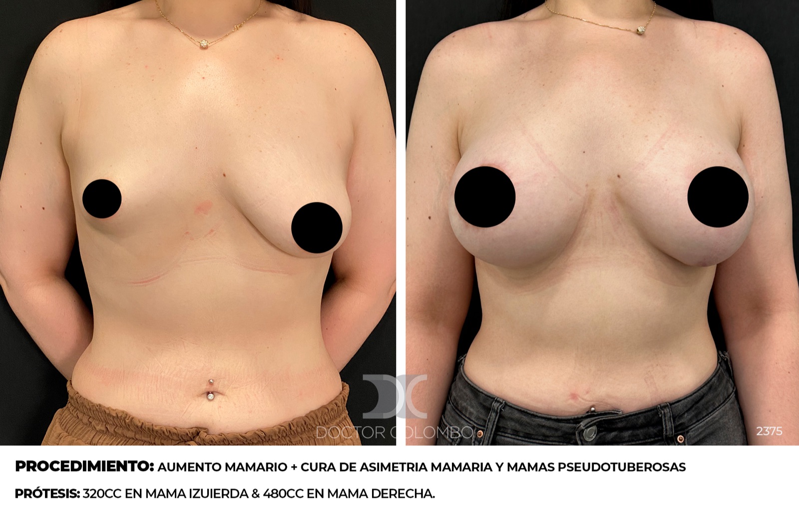 Antes y despues Mamas Tubulares