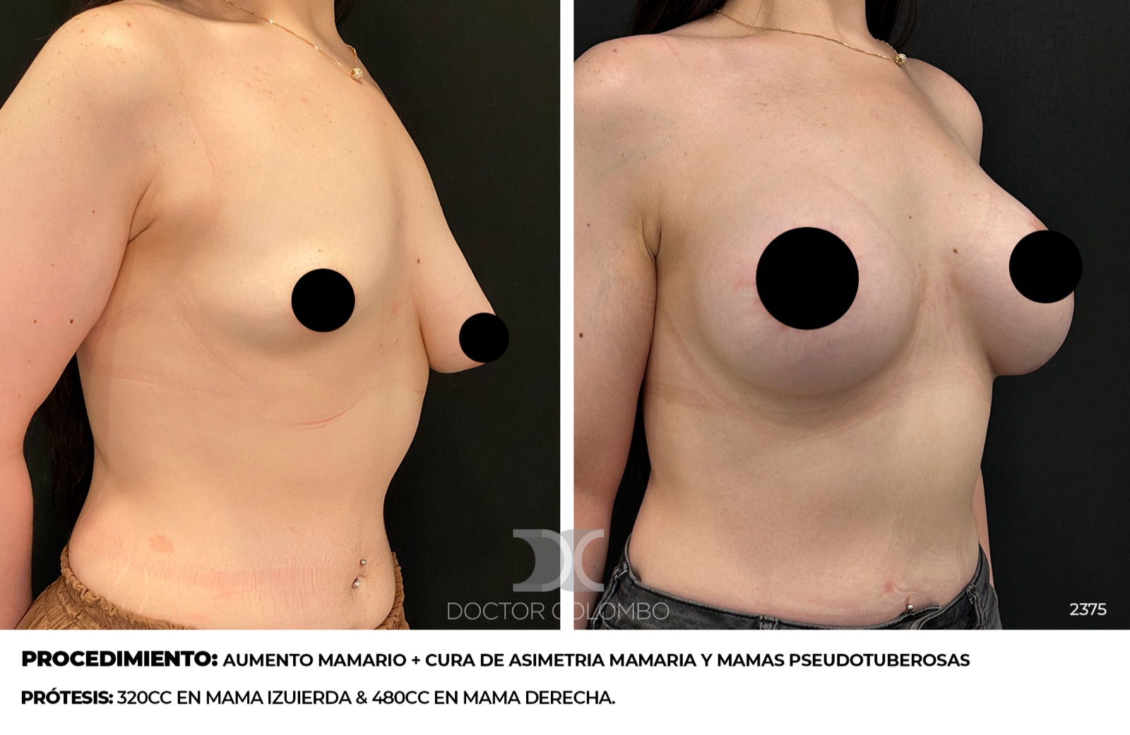 Antes y después corrección de asimetría mamaria - Dr. Colombo, vista lateral