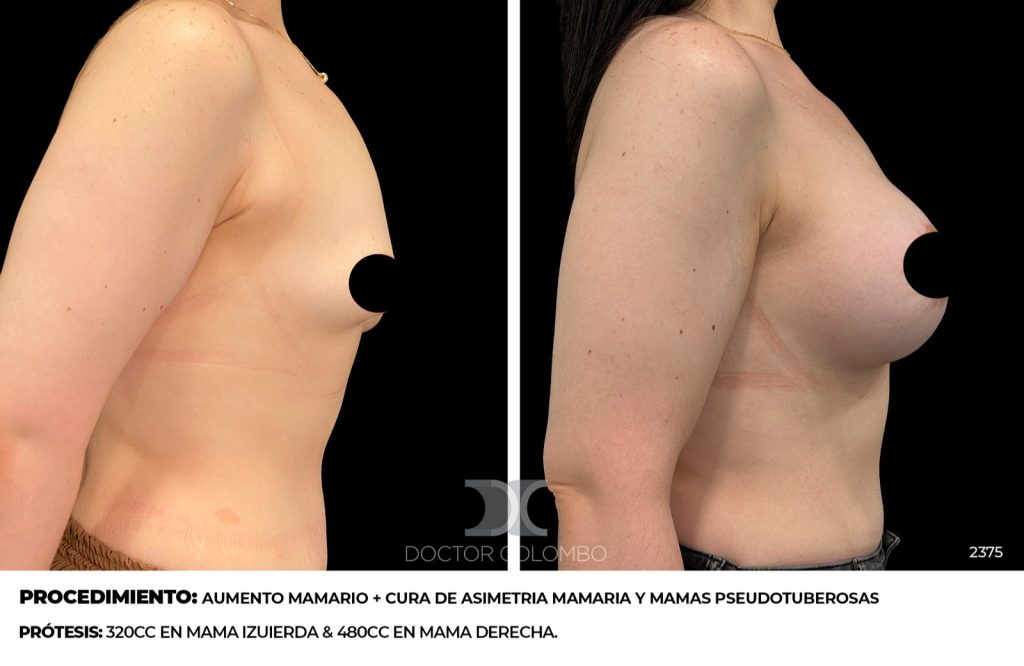 AUMENTO MAMARIO + CURA DE ASIMETRIA MAMARIA Y MAMAS PSEUDOTUBEROSAS .  CON  PERIAROLAR DCHA  450CC APROX Y T INVERTIDA IZDA  350CC APROX – SE QUITO EN BALON GASTRICO??? — 2375 — Vista 1
