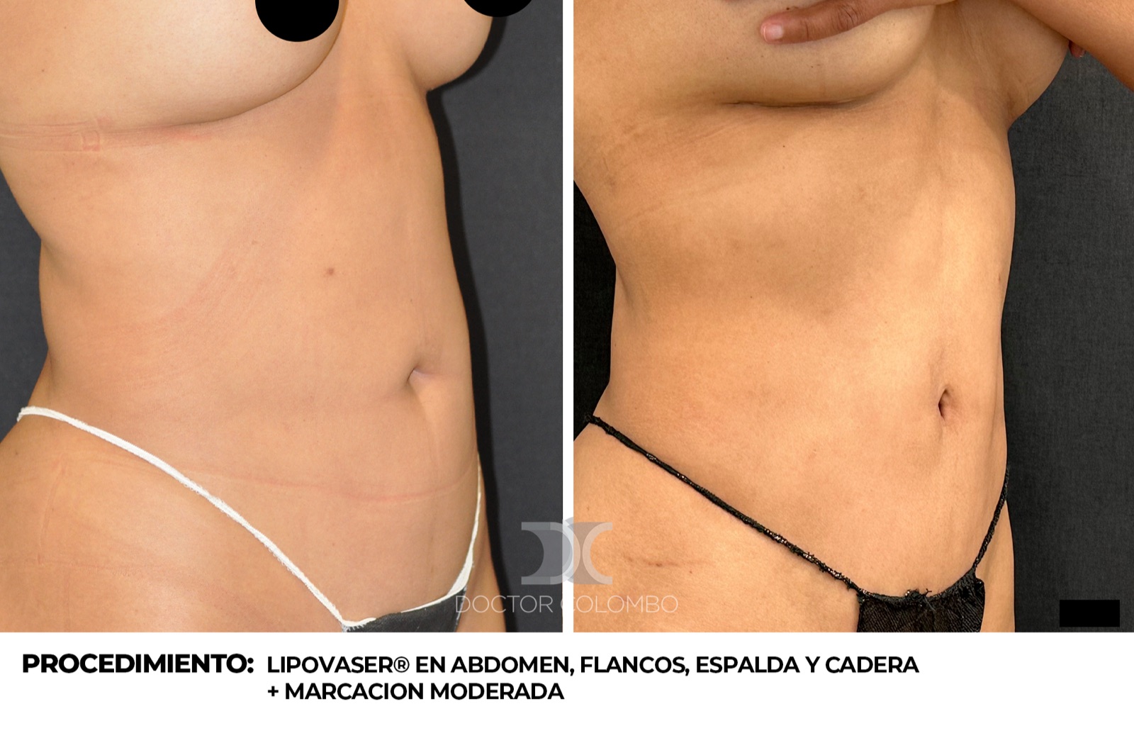 Antes y después liposucción VASER - Dr. Colombo Madrid