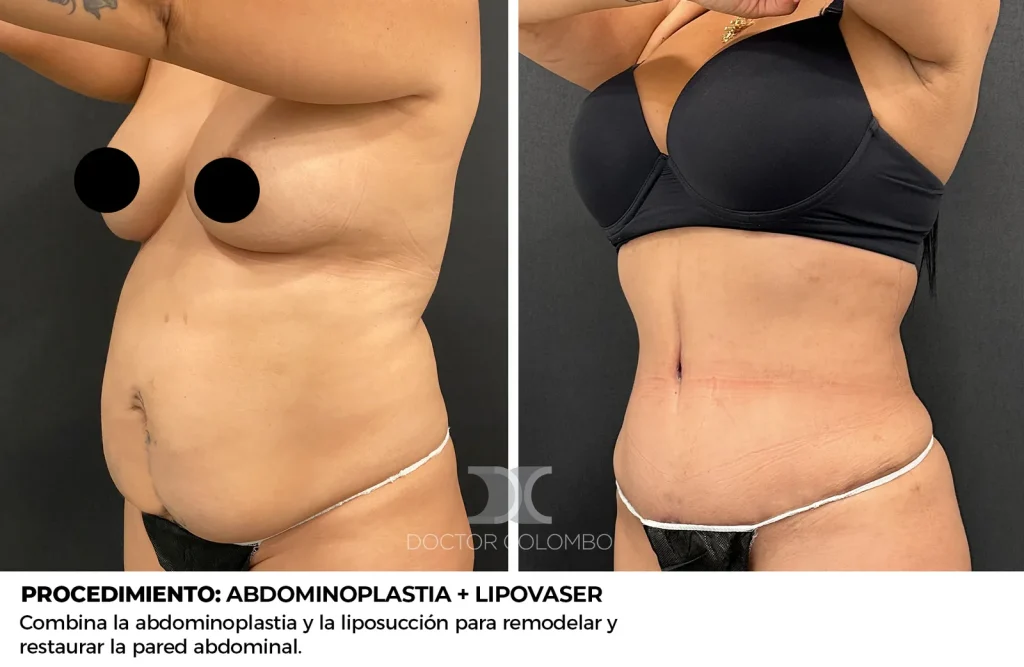 ABDOMINOPLASTIA + LIPOSUCCIÓN VASER® DE ABDOMEN, FLANCOS, ESPALDA + LIPOTRANSFERENCIA A GLÚTEOS — 1352 — Perfil izquierdo