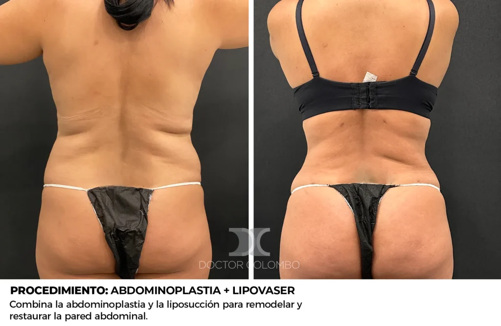 ABDOMINOPLASTIA + LIPOSUCCIÓN VASER® DE ABDOMEN, FLANCOS, ESPALDA + LIPOTRANSFERENCIA A GLÚTEOS — 1352 — Frontal