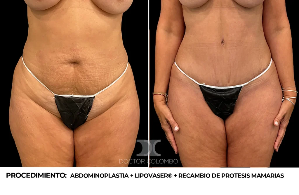 ABDOMINOPLASTIA + LIPOSUCCIÓN VASER® DE ABDOMEN + RECAMBIO DE PROTESIS MAMARIAS –  CON NOCHE DE HOSPITALIZACIÓN — 2382 — Perfil derecho