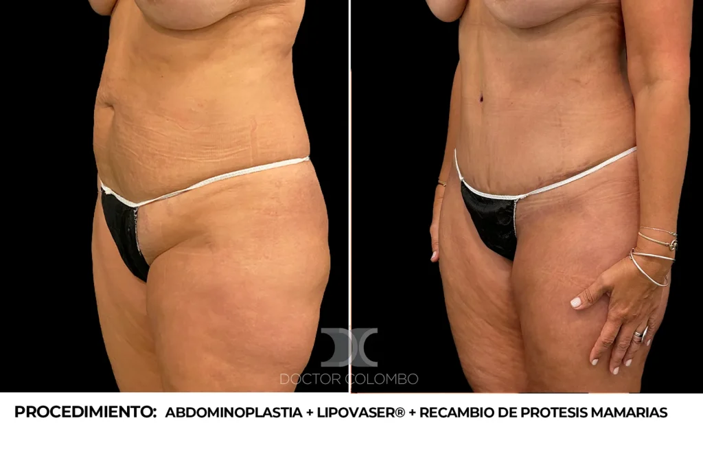 ABDOMINOPLASTIA + LIPOSUCCIÓN VASER® DE ABDOMEN + RECAMBIO DE PROTESIS MAMARIAS –  CON NOCHE DE HOSPITALIZACIÓN — 2382 — Perfil izquierdo