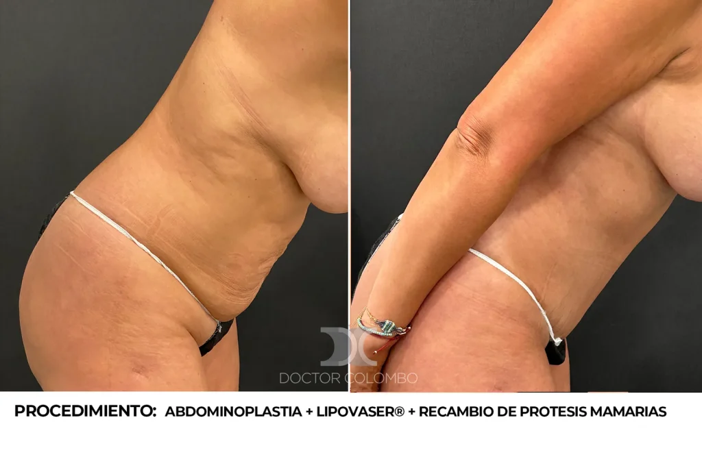 ABDOMINOPLASTIA + LIPOSUCCIÓN VASER® DE ABDOMEN + RECAMBIO DE PROTESIS MAMARIAS –  CON NOCHE DE HOSPITALIZACIÓN — 2382 — Frontal