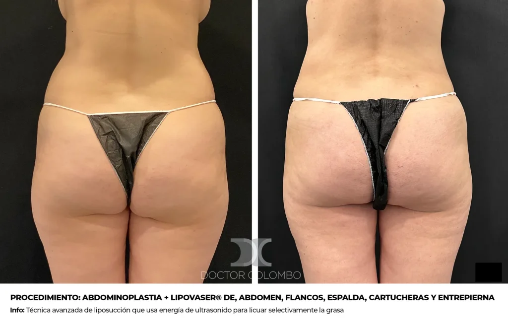 ABDOMINOPLASTIA CON VERTICAL + LIPOSUCCIÓN VASER® DE, ABDOMEN, FLANCOS, ESPALDA, CARTUCHERAS Y ENTREPIERNA — 2601 — Vista 1