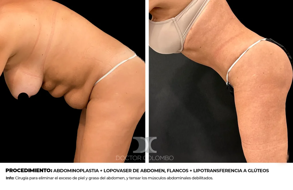 ABDOMINOPLASTIA + LOPOSUCCIÓN VASER DE ABDOMEN, FLANCOS Y  CADERAS + LIPOTRANSFERENCIA A GLÚTEOS — 2862 — Vista 1