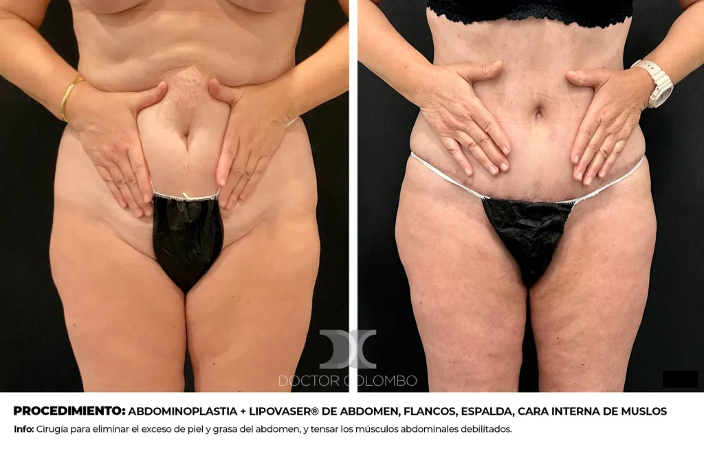 ABDOMINOPLASTIA + LIPOSUCCIÓN VASER® DE ABDOMEN, FLANCOS, ESPALDA, CARA INTERNA DE MUSLOS Y RODILLAS + SUPRAROTULIANO – CON NOCHE DE HOSPITALIZACIÓN — 3390 — Vista 1