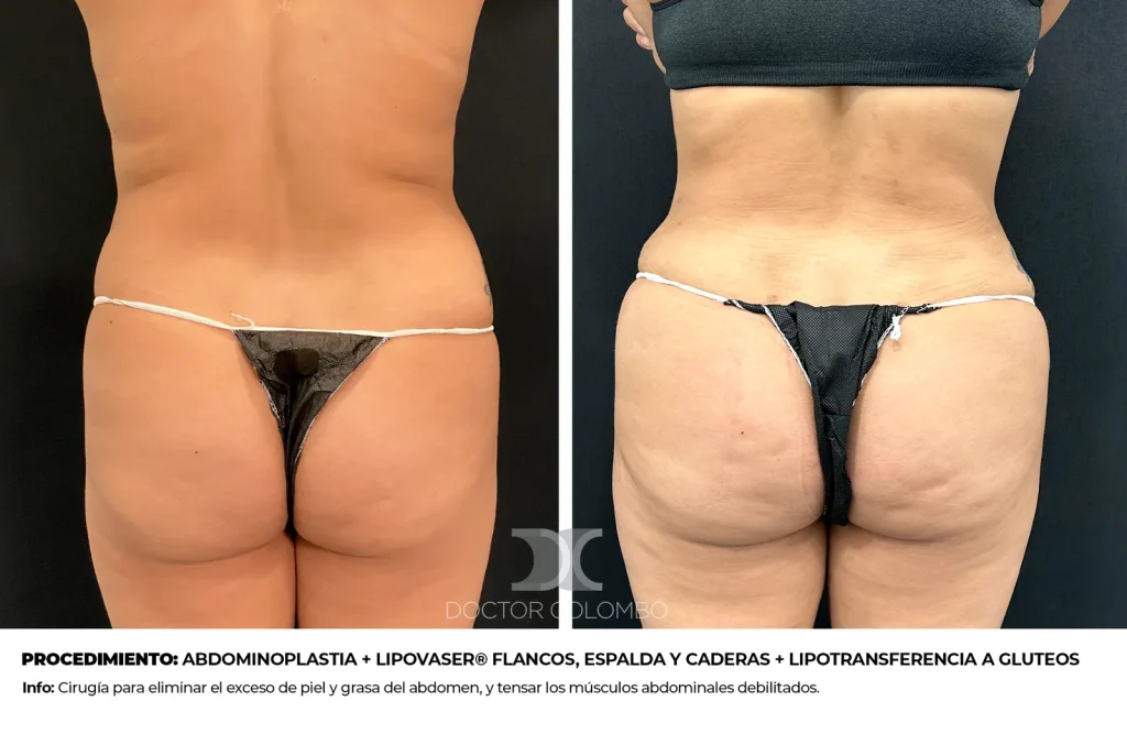 ABDOMINOPLASTIA + LIPOSUCCIÓN VASER® EN ABDOMEN, FLANCOS, ESPALDA Y CADERAS + LIPOTRANSFERENCIA A GLUTEOS — 654 — Vista 1