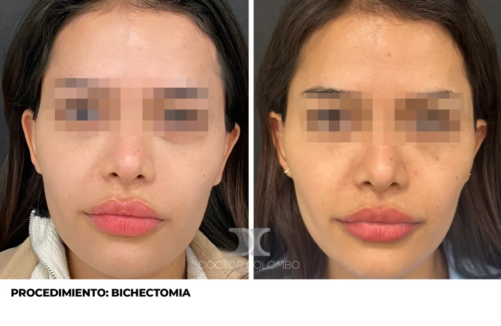 BICHECTOMIA + BOTOX — 3111 — Perfil derecho