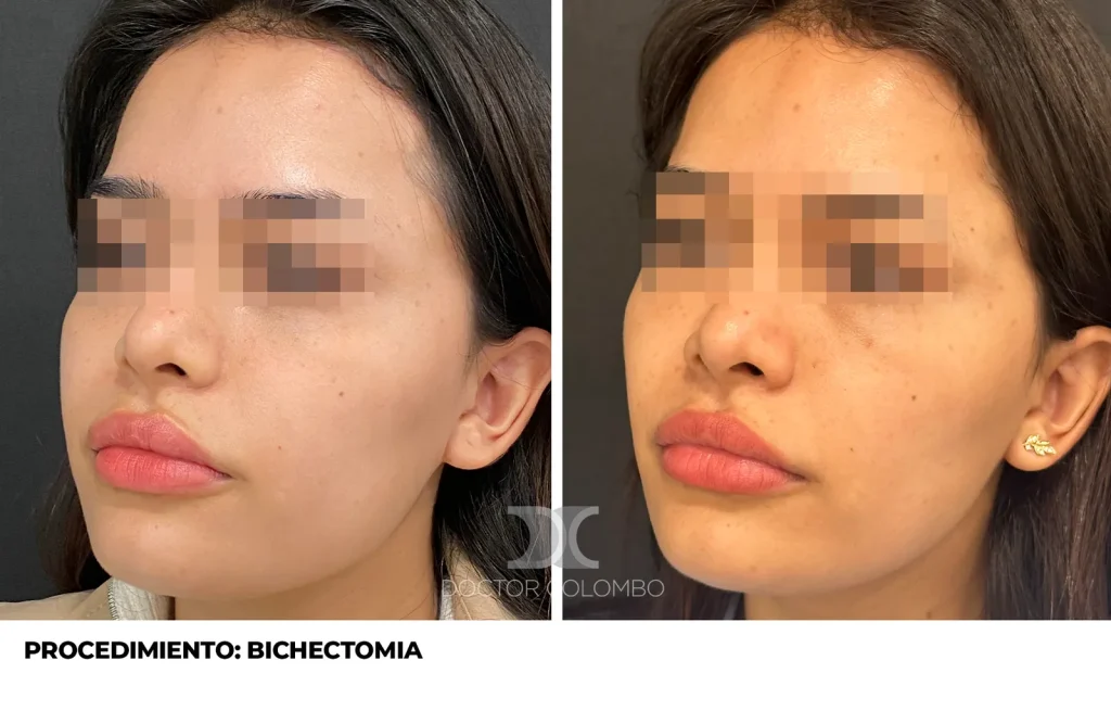 BICHECTOMIA + BOTOX — 3111 — Perfil izquierdo