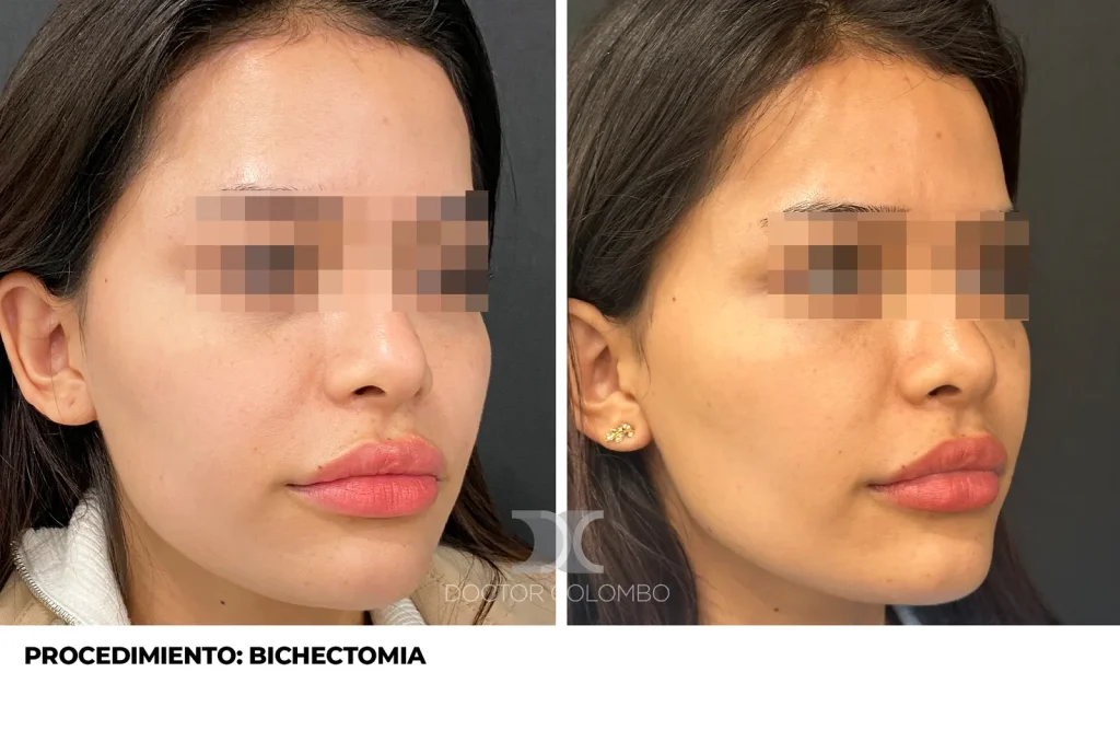 BICHECTOMIA + BOTOX — 3111 — Frontal