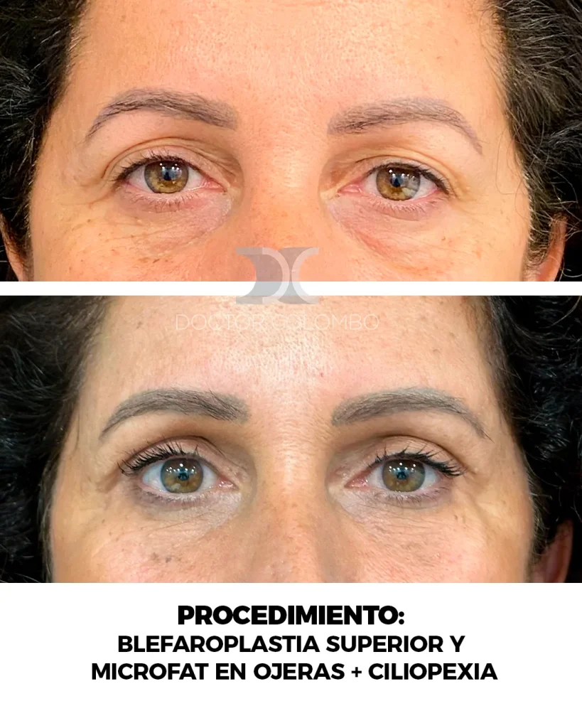 BLEFAROPLASTIA SUPERIOR Y MICROFAT EN OJERAS + CILIOPEXIA ENDOPSCOPICA — 158 — Perfil izquierdo