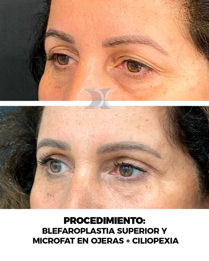 BLEFAROPLASTIA SUPERIOR Y MICROFAT EN OJERAS + CILIOPEXIA ENDOPSCOPICA — 158 — Frontal